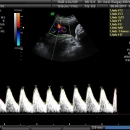 Doppler A Umbillicalis