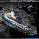 Aorta